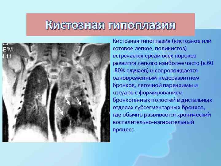 Кистозная гипоплазия (кистозное или сотовое легкое, поликистоз) встречается среди всех пороков развития легкого наиболее