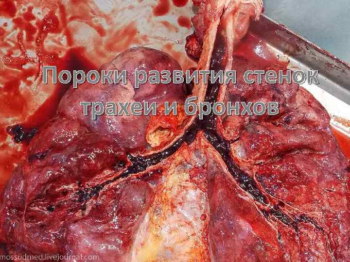 Пороки развития стенок трахеи и бронхов 