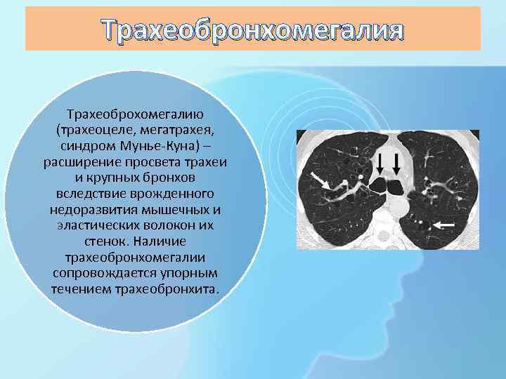 Трахеобронхомегалия Трахеоброхомегалию (трахеоцеле, мегатрахея, синдром Мунье-Куна) – расширение просвета трахеи и крупных бронхов вследствие