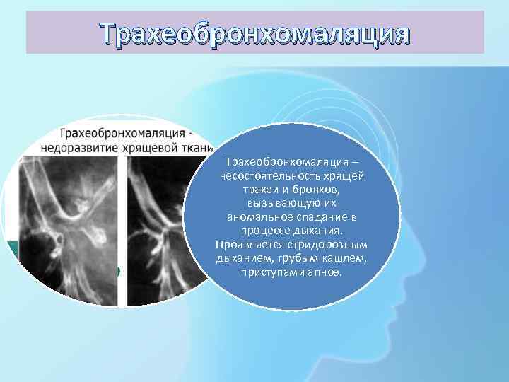 Трахеобронхомаляция – несостоятельность хрящей трахеи и бронхов, вызывающую их аномальное спадание в процессе дыхания.