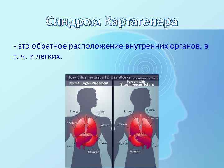Синдром Картагенера - это обратное расположение внутренних органов, в т. ч. и легких. 