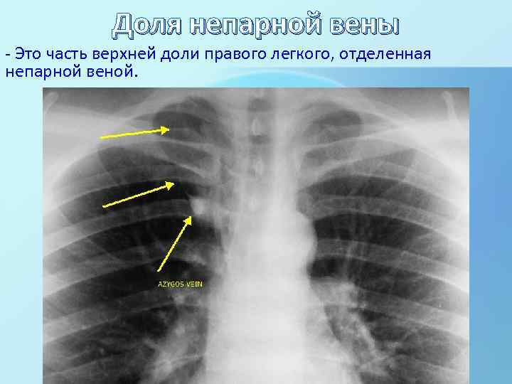 Доля непарной вены - Это часть верхней доли правого легкого, отделенная непарной веной. 