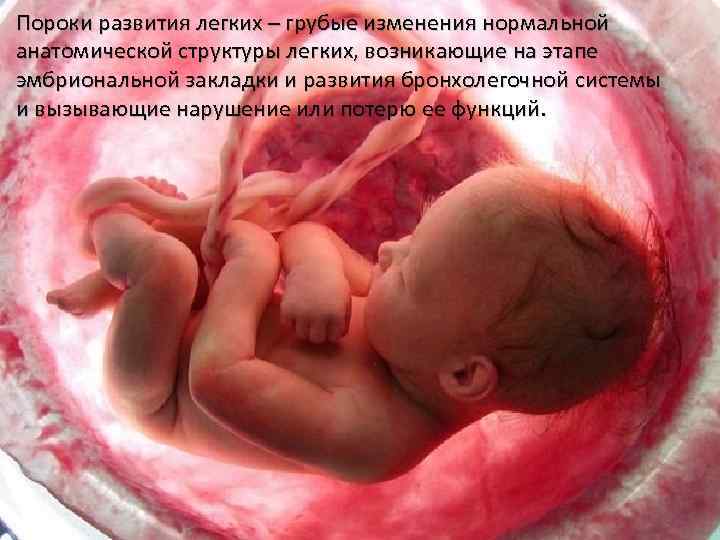 Пороки развития легких – грубые изменения нормальной анатомической структуры легких, возникающие на этапе эмбриональной