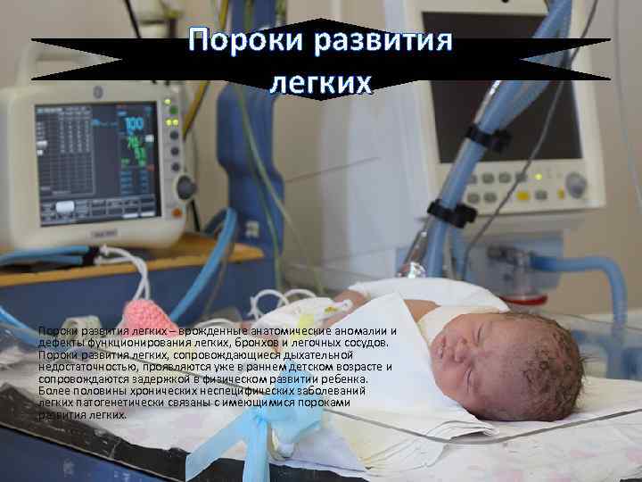 Пороки развития легких – врожденные анатомические аномалии и дефекты функционирования легких, бронхов и легочных