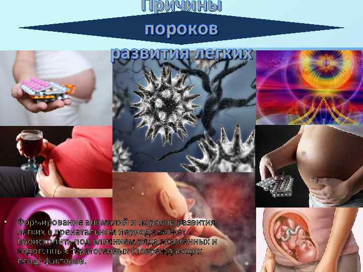 Причины пороков развития легких • Формирование аномалий и пороков развития легких в пренатальном периоде