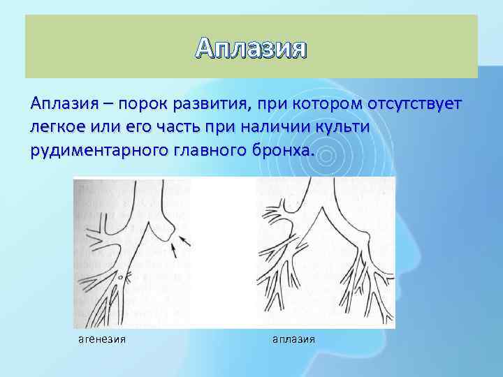 Аплазия – порок развития, при котором отсутствует легкое или его часть при наличии культи