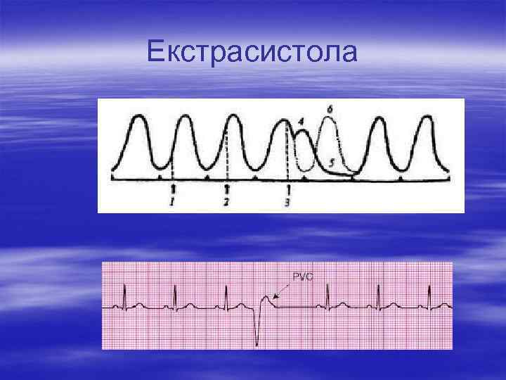 Екстрасистола 