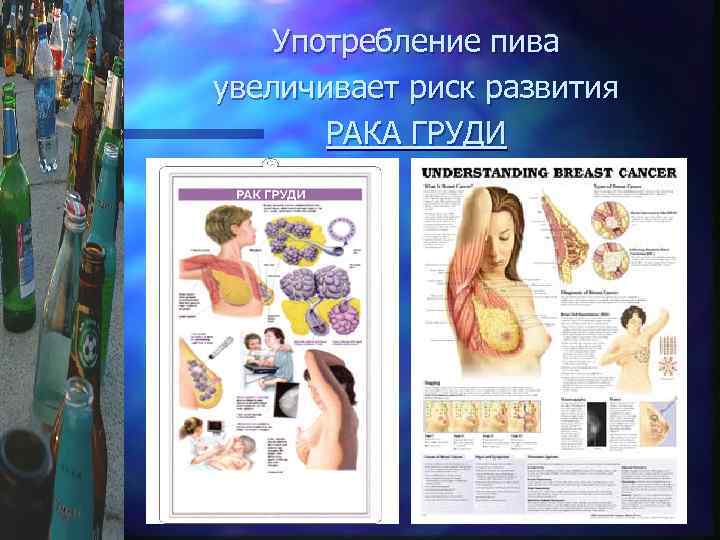 Употребление пива увеличивает риск развития РАКА ГРУДИ 