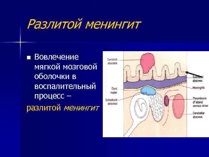 Разлитой менингит Вовлечение мягкой мозговой оболочки в воспалительный процесс – разлитой менингит n 