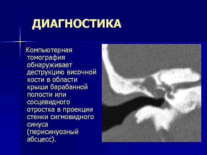 Стенки сосцевидного отростка