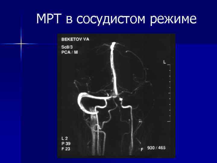 МРТ в сосудистом режиме 