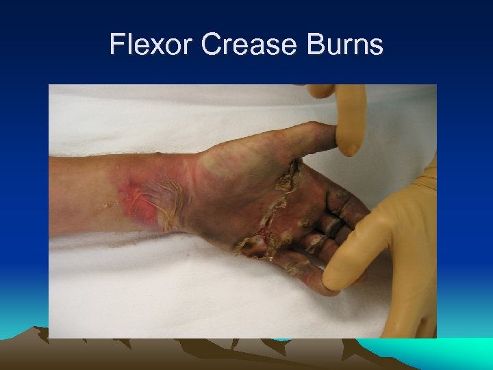 Flexor Crease Burns 