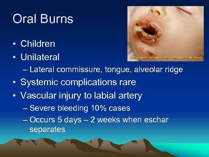 Oral Burns • Children • Unilateral – Lateral commissure, tongue, alveolar ridge • Systemic