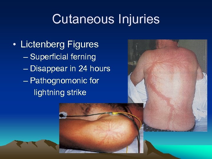 Cutaneous Injuries • Lictenberg Figures – Superficial ferning – Disappear in 24 hours –