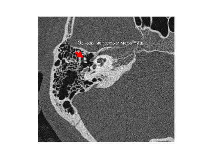 Основание головки молоточка 