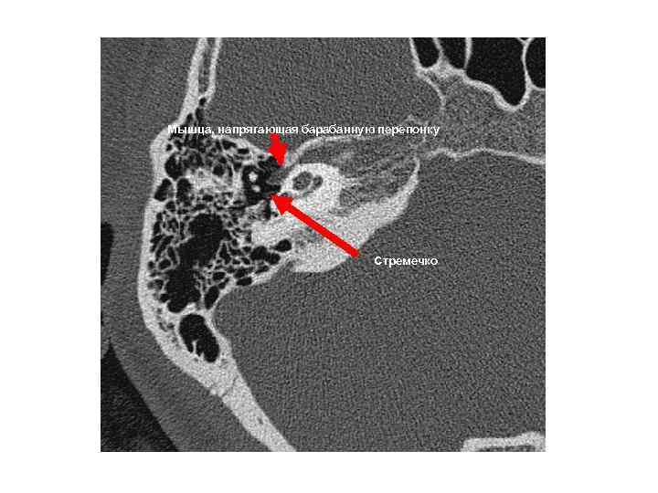 Мышца, напрягающая барабанную перепонку Стремечко 
