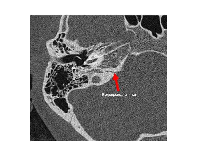 Водопровод улитки 