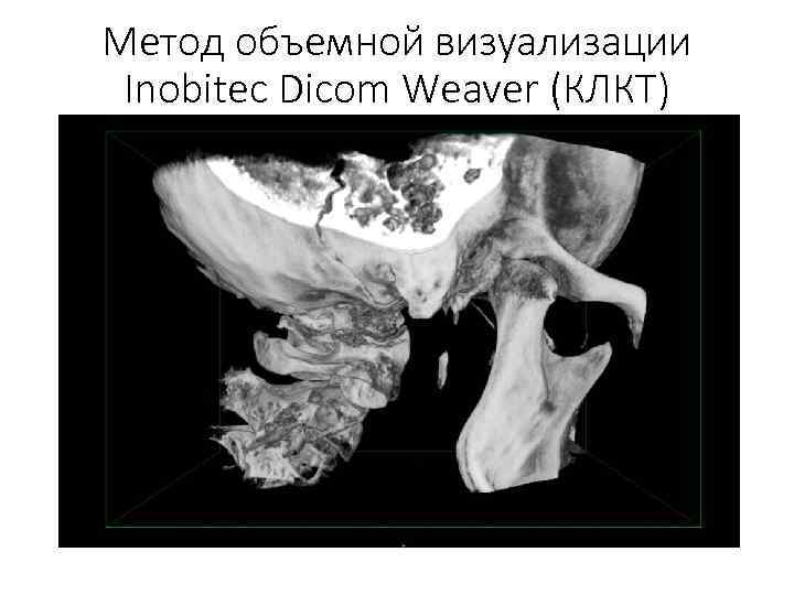Метод объемной визуализации Inobitec Dicom Weaver (КЛКТ) 