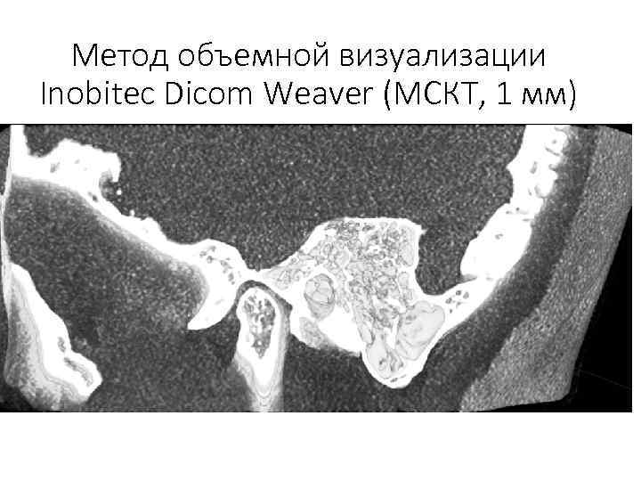 Метод объемной визуализации Inobitec Dicom Weaver (МСКТ, 1 мм) 