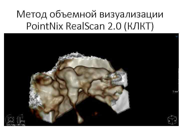 Метод объемной визуализации Point. Nix Real. Scan 2. 0 (КЛКТ) 