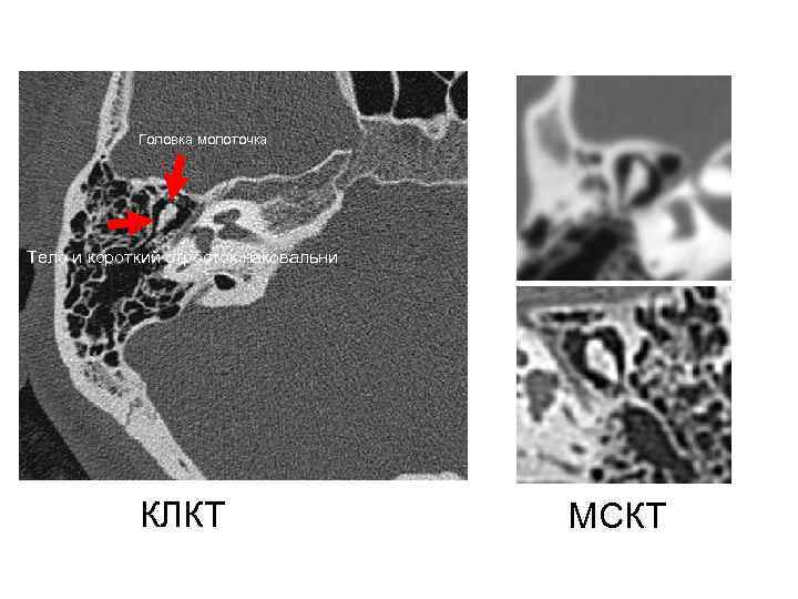 Головка молоточка Тело и короткий отросток наковальни КЛКТ МСКТ 