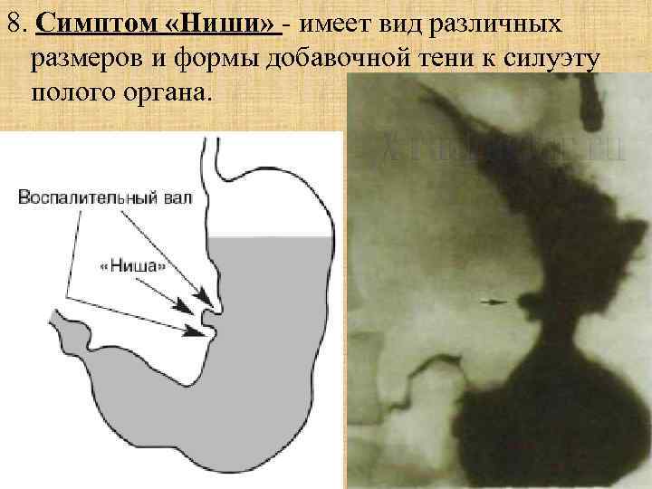 Прободение полого органа рентген схема