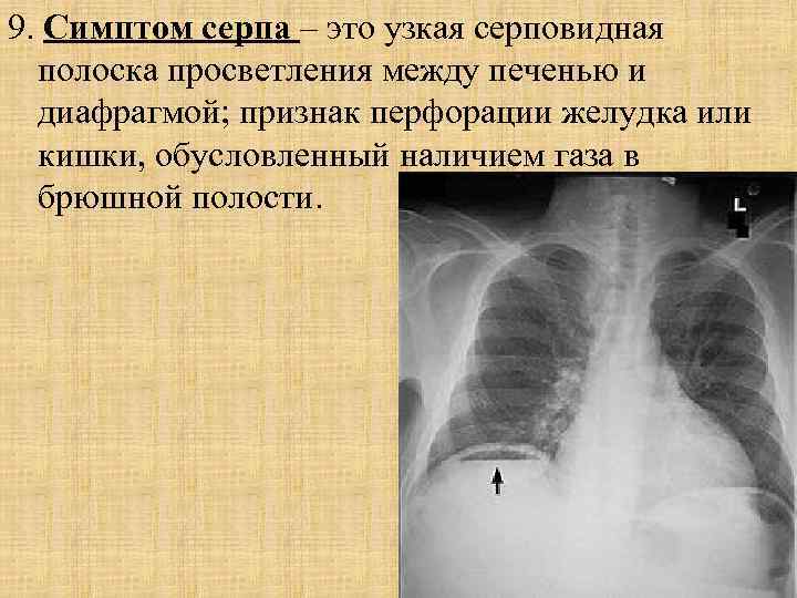 9. Симптом серпа – это узкая серповидная полоска просветления между печенью и диафрагмой; признак