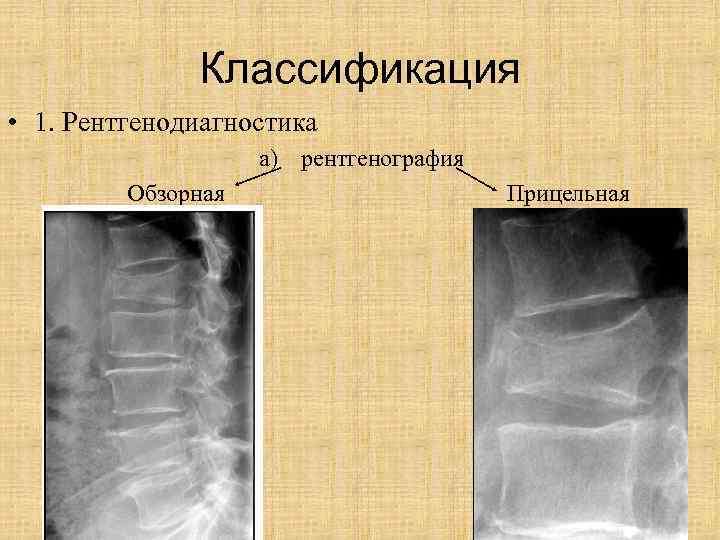 Классификация • 1. Рентгенодиагностика a) рентгенография Обзорная Прицельная 