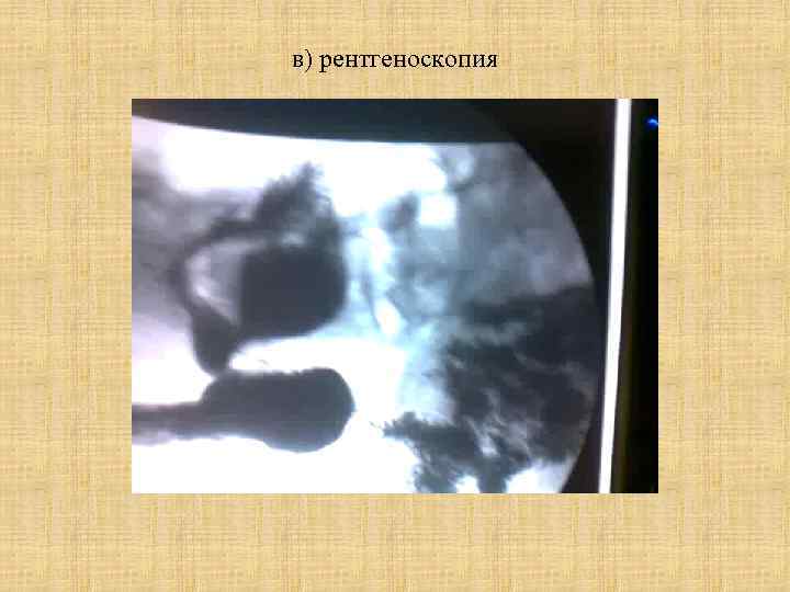 в) рентгеноскопия 
