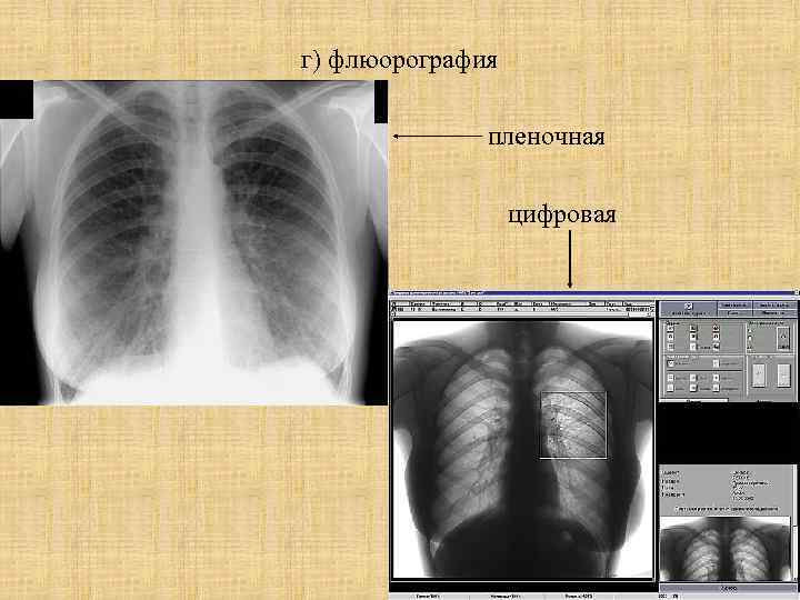 г) флюорография пленочная цифровая 