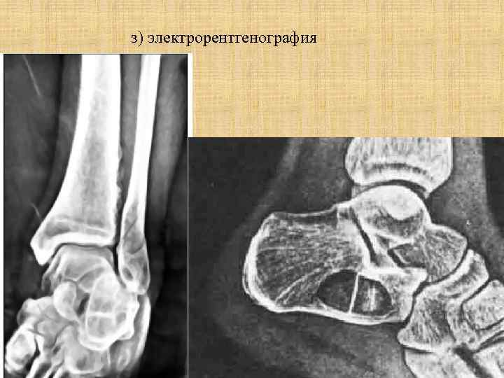 При электрорентгенографии изображение получают