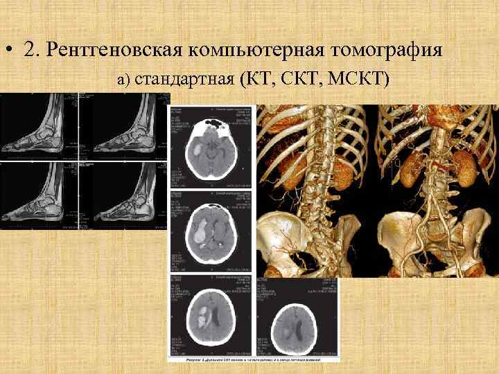  • 2. Рентгеновская компьютерная томография а) стандартная (КТ, СКТ, МСКТ) 