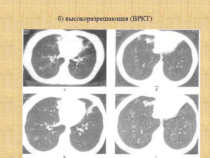 б) высокоразрешающая (ВРКТ) 