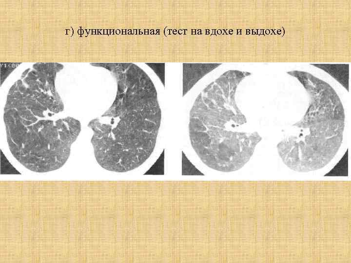 г) функциональная (тест на вдохе и выдохе) 