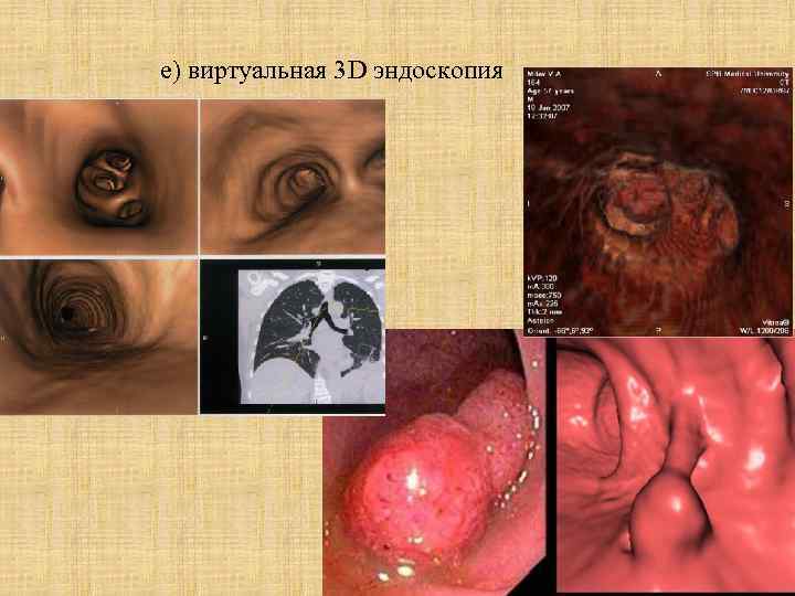  е) виртуальная 3 D эндоскопия 