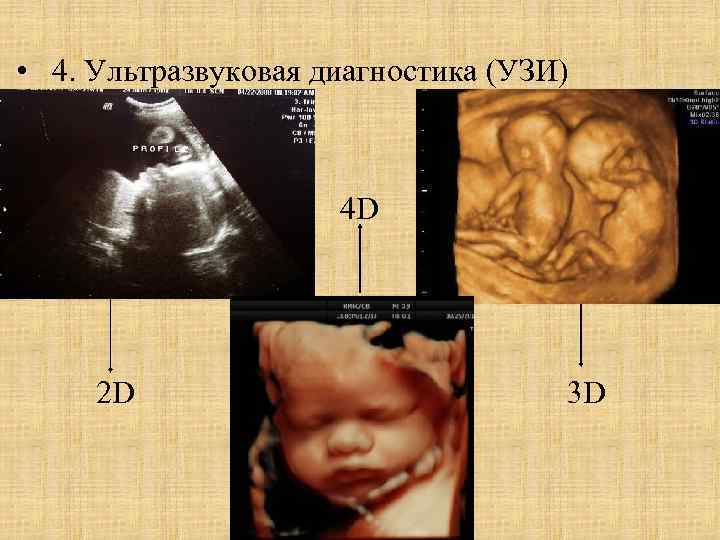  • 4. Ультразвуковая диагностика (УЗИ) • 4 D 2 D 3 D 