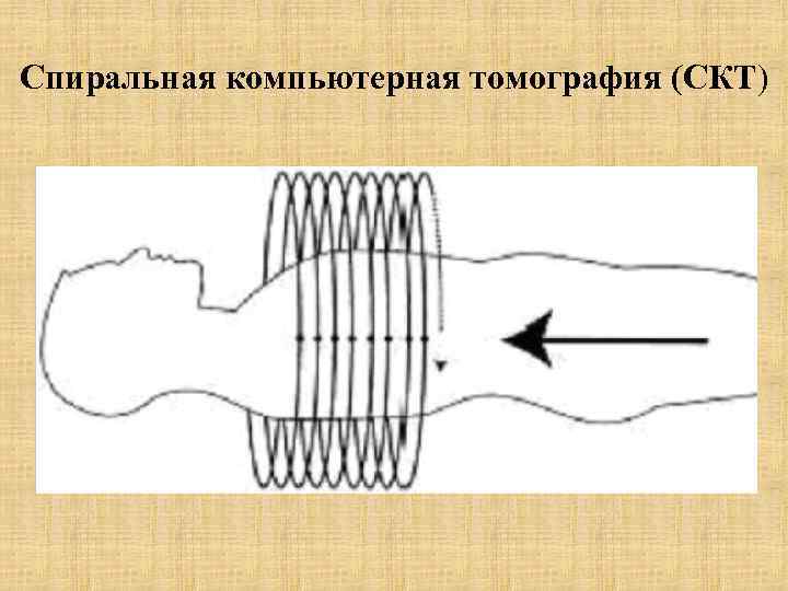 Спиральная компьютерная томография (СКТ) 