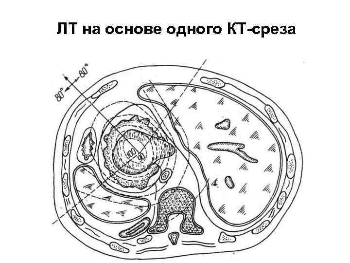 ЛТ на основе одного КТ-среза 