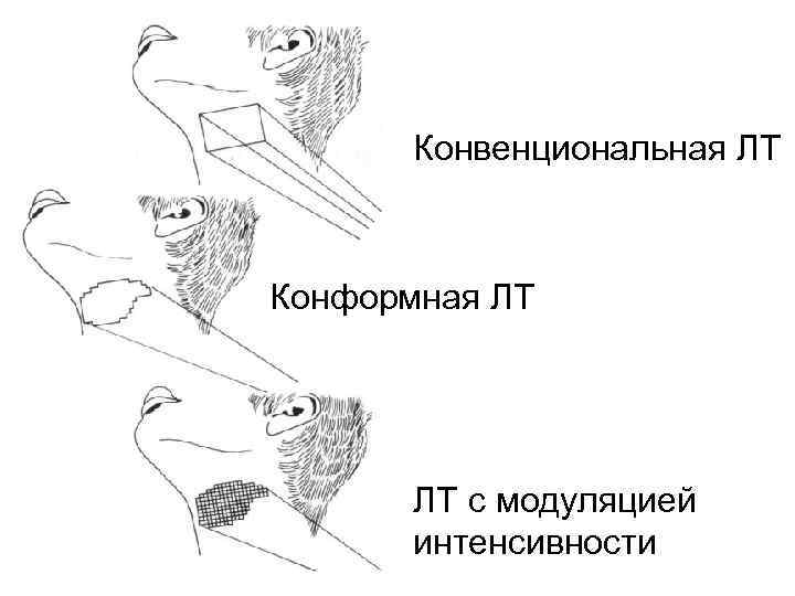 Конвенциональная ЛТ Конформная ЛТ ЛТ с модуляцией интенсивности 