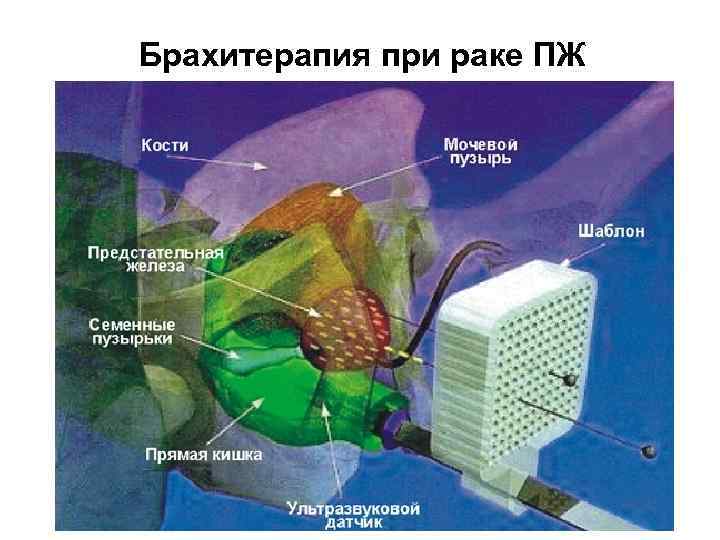 Брахитерапия при раке ПЖ 