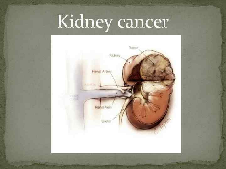Kidney cancer 