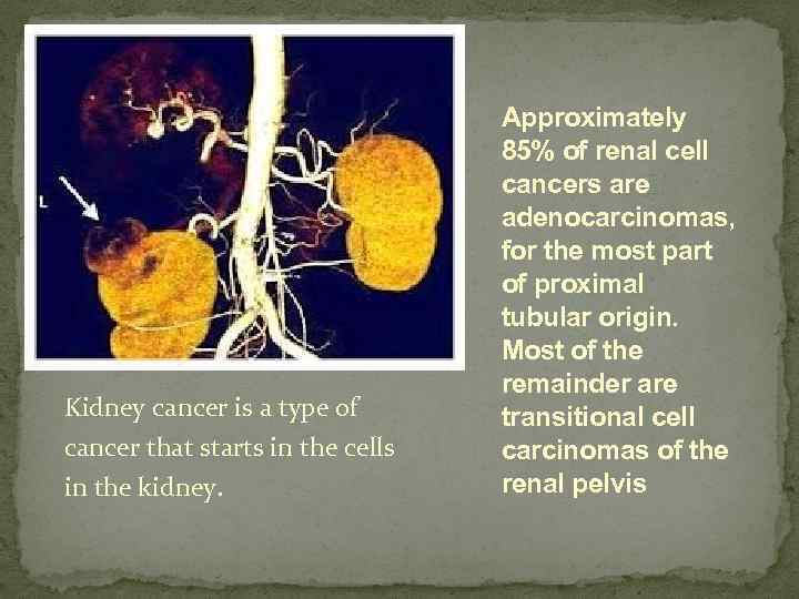 Kidney cancer is a type of cancer that starts in the cells in the