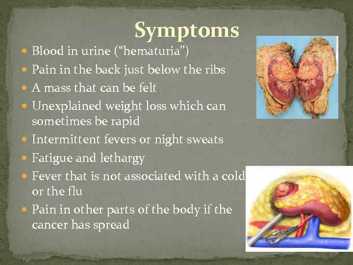Symptoms Blood in urine (“hematuria”) Pain in the back just below the ribs A
