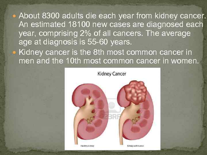  About 8300 adults die each year from kidney cancer. An estimated 18100 new