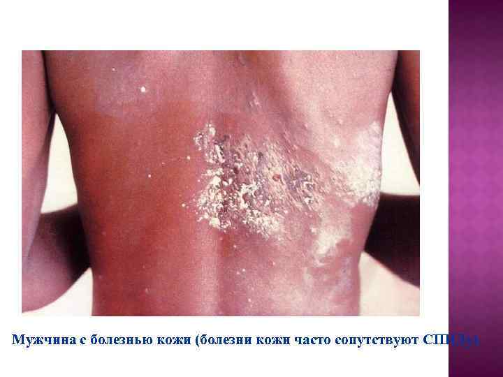 Мужчина с болезнью кожи (болезни кожи часто сопутствуют СПИДу). 