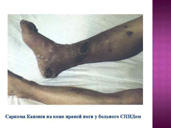Саркома Капоши на коже правой ноги у больного СПИДом 