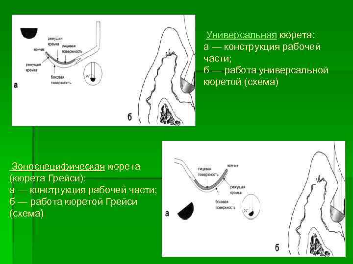  Универсальная кюрета: а — конструкция рабочей части; б — работа универсальной кюретой (схема)