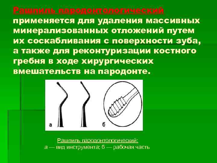 Рашпиль пародонтологический применяется для удаления массивных минерализованных отложений путем их соскабливания с поверхности зуба,