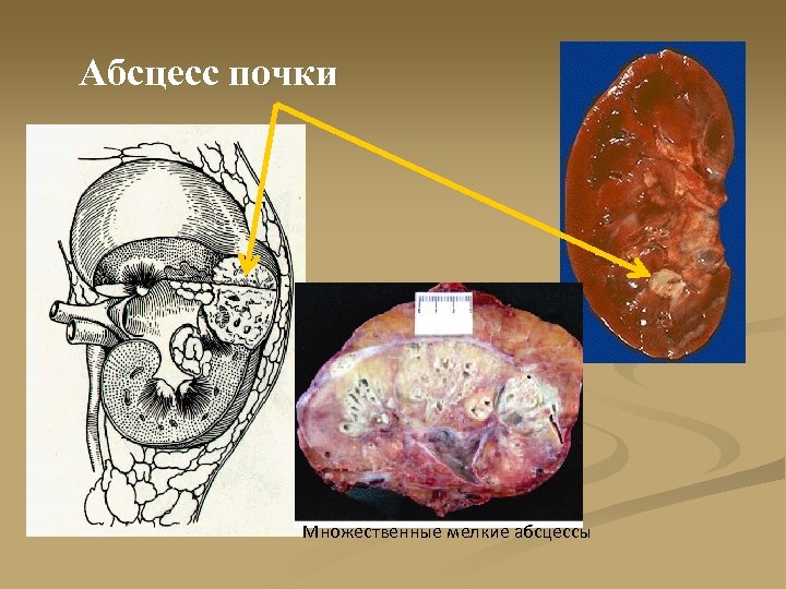 Абсцесс почки Множественные мелкие абсцессы 