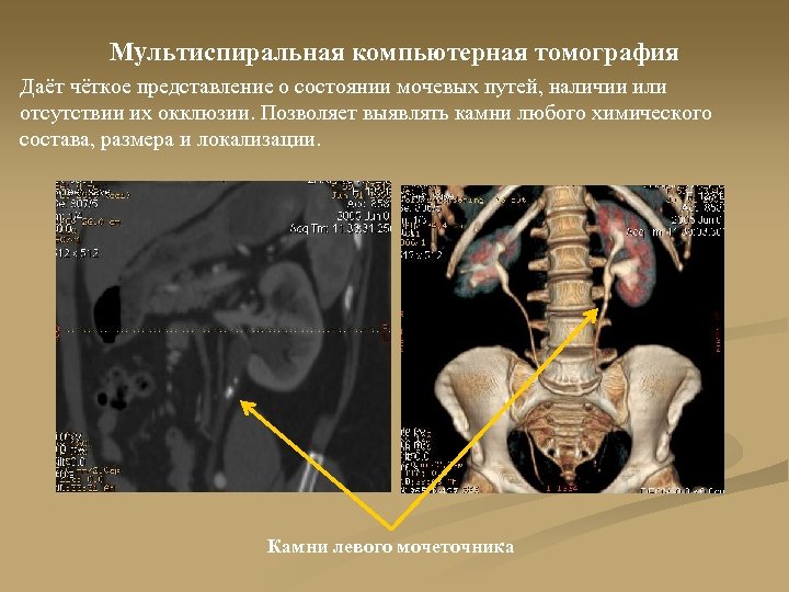 Мультиспиральная компьютерная томография коронарных артерий что это